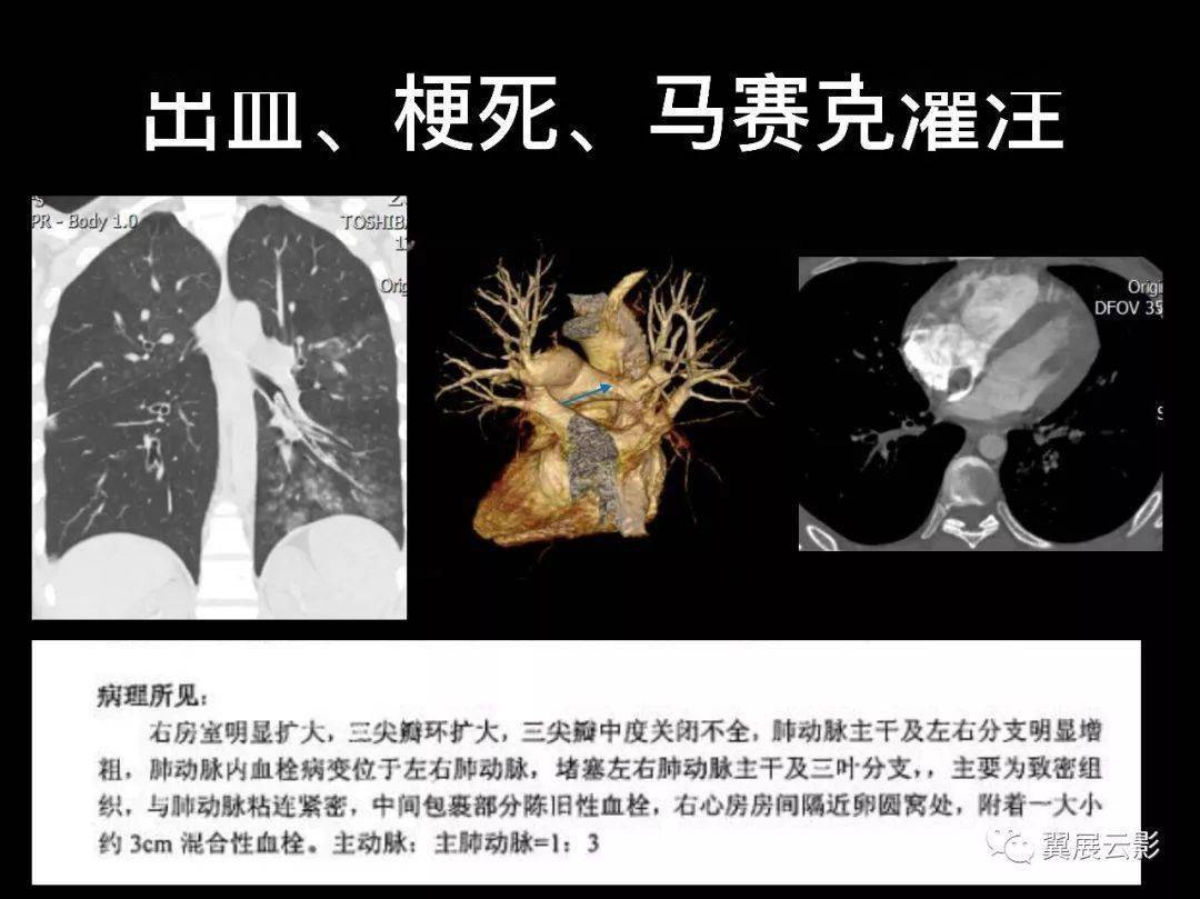 肺栓塞的影像诊断与鉴别诊断