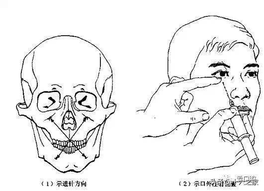 (3)眶下神经阻滞麻醉 口内法 图示同图—36