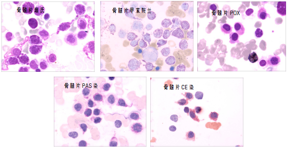 pox(-)100%;pas(-)10%,( )14%,(   )76%;nas-dce( )100%;甲苯胺蓝染色