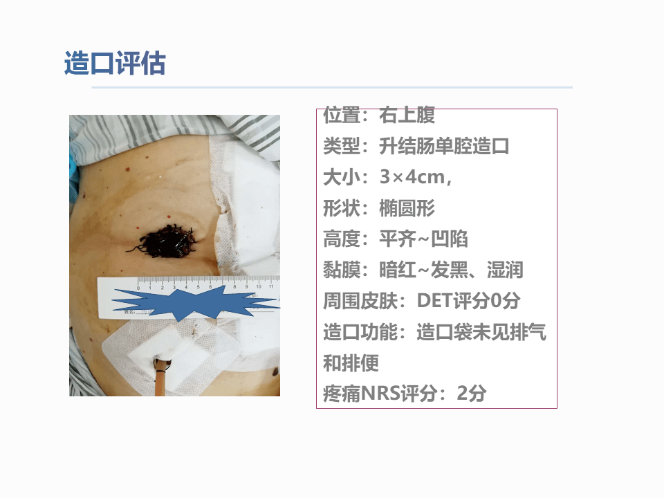 一例结肠癌术后肠造口缺血坏死护理查房