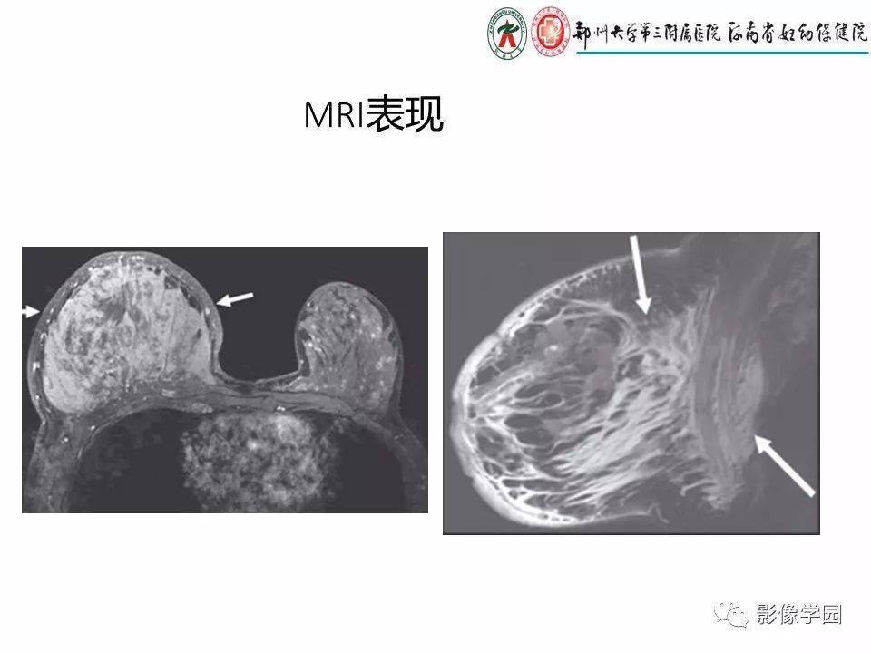非哺乳期乳腺炎性病变与炎性乳癌影像诊断