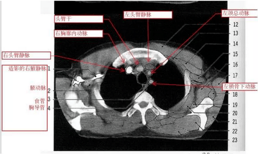 正常胸部ct层面较多,每一层面结构所表现的图像不同.