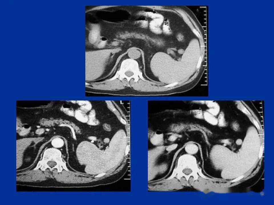 脾脏疾病的ct诊断