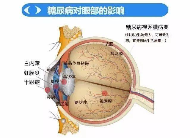 健康科普│糖尿病与眼部疾病