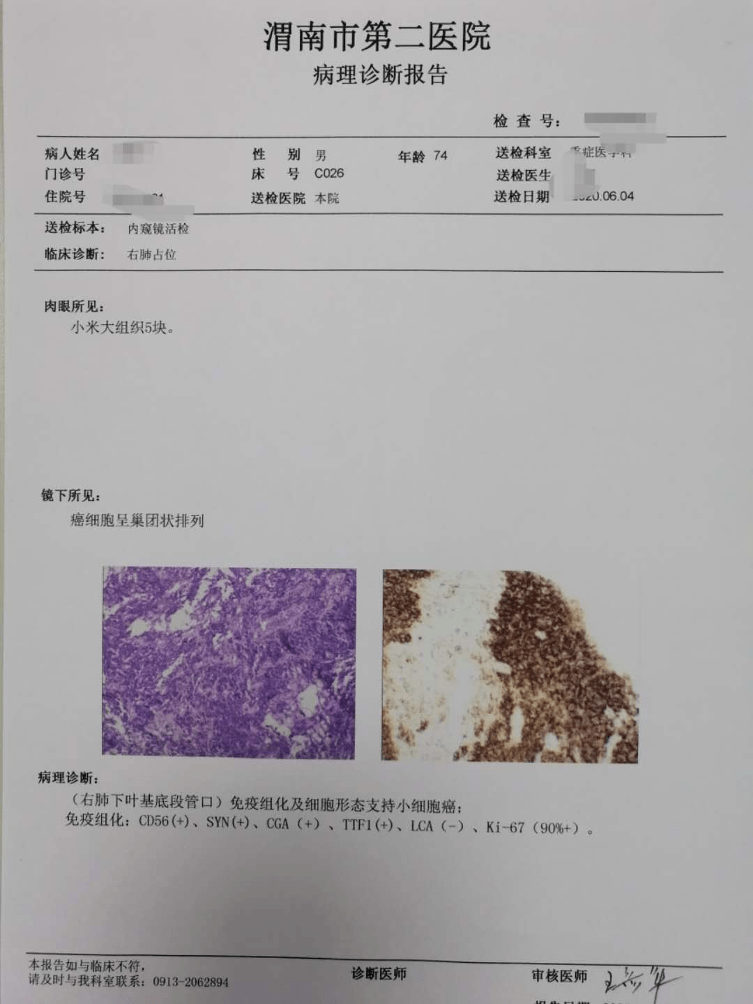 病理诊断报告该例患者,er(   )提示可以用内分泌治疗方案,her-2(-)