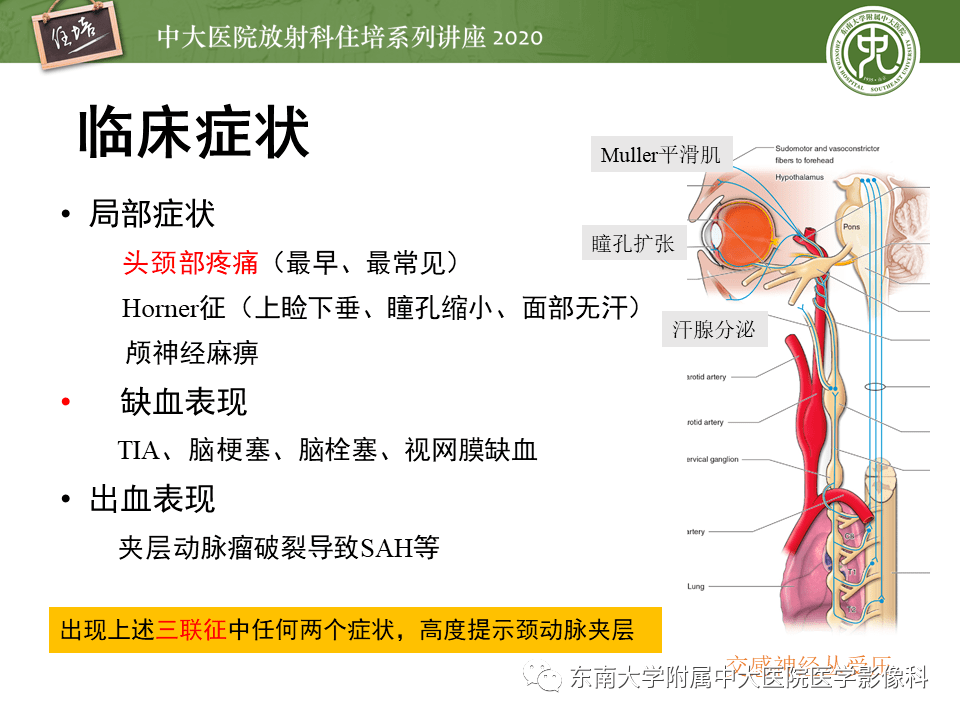 颈动脉夹层及夹层动脉瘤的影像诊断及评估