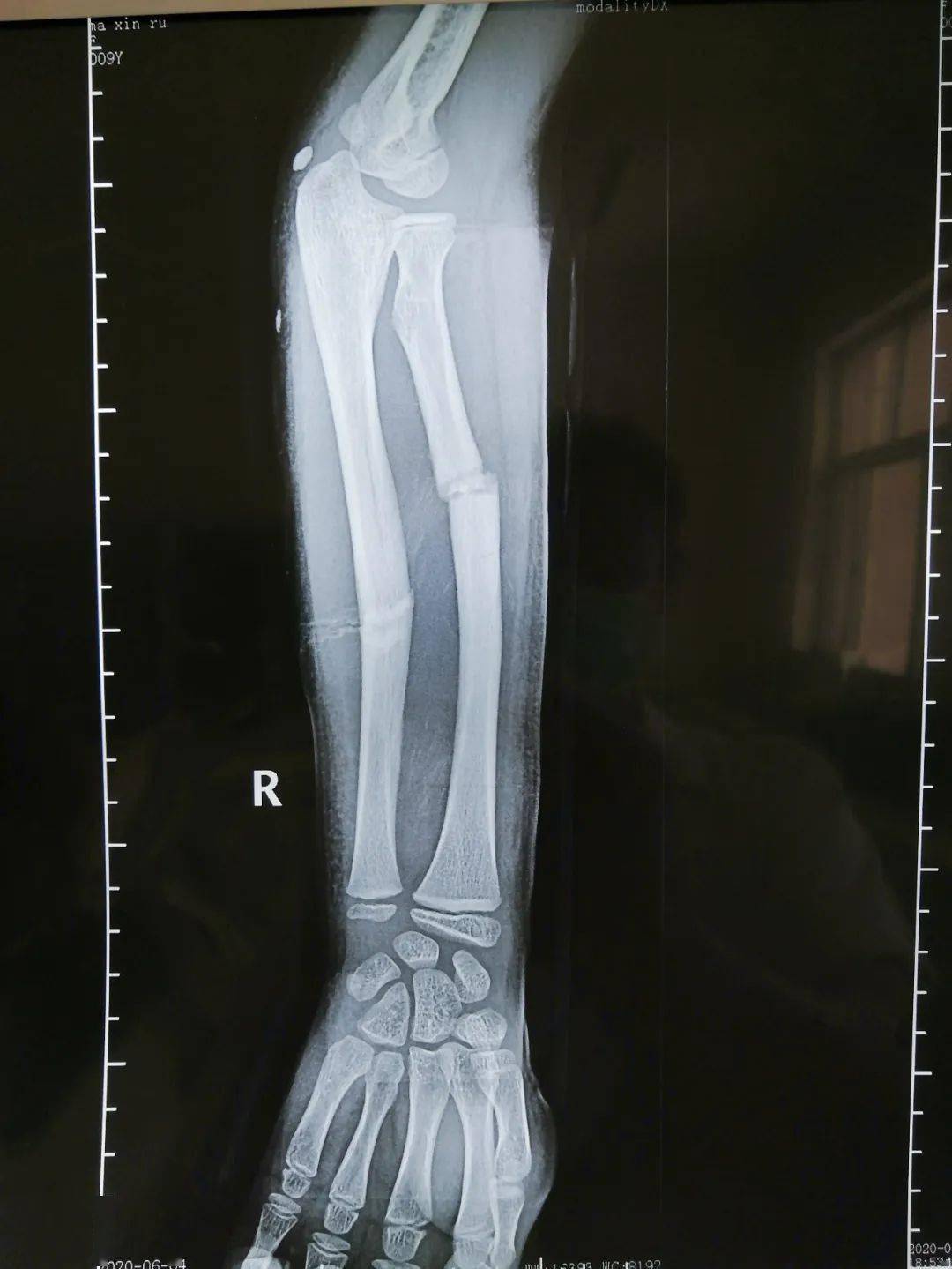 手臂骨折的男孩照片摄影图片_ID:147966818-Veer图库