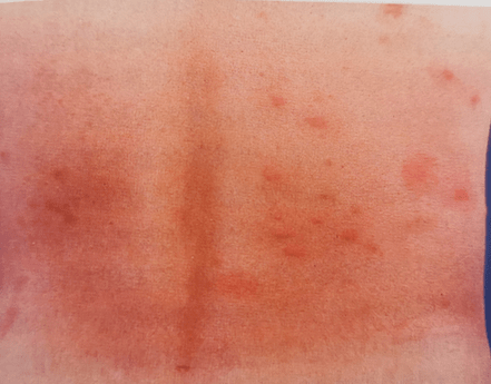 臭虫 粉螨 螨虫皮炎 先感瘙痒,夜间为甚,局部出现水肿性红斑,丘疹,丘