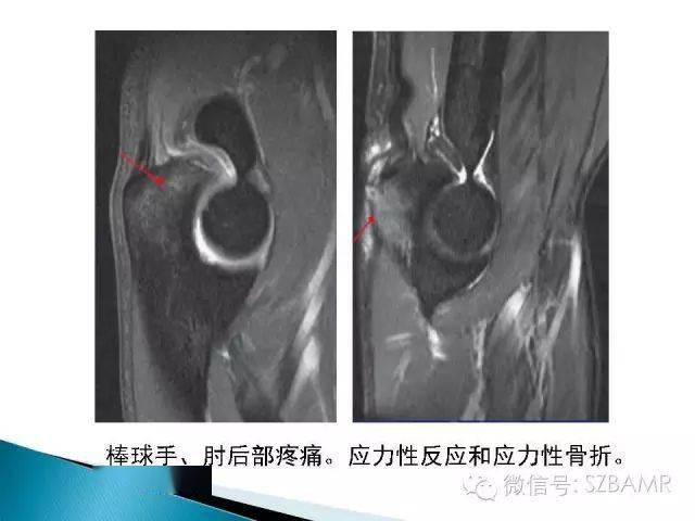 影像解剖肘关节mri图谱超全整理