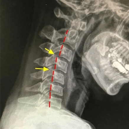 多抬头  如果"动力性过伸位"没有错位,但颈椎侧位片显示颈椎变直甚至