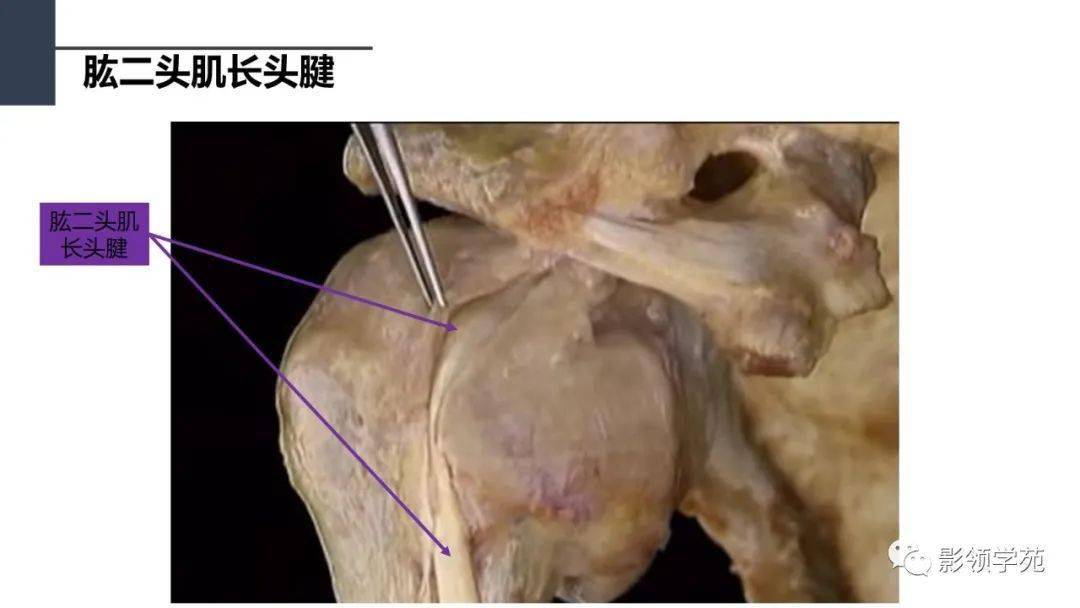 肩关节解剖及常见疾病影像表现