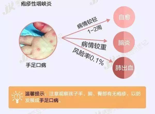 孩子|幼儿疱疹性咽峡炎进入高发期！家里有孩子的一定要注意！