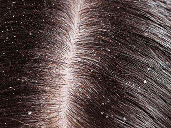 李佳琦推荐的脱发克星!一次就能拯救头屑头痒头油,用了它头发都会跳舞!