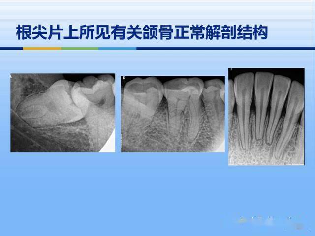 牙体牙周正常解剖及常见病x线表现