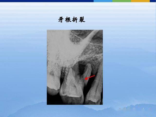 牙体牙周正常解剖及常见病x线表现