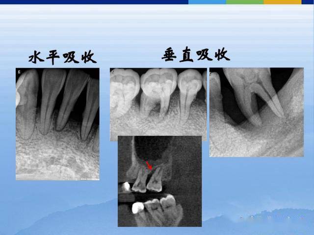 牙体牙周正常解剖及常见病x线表现