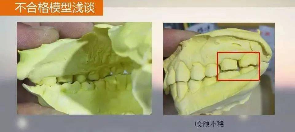 外展隙处理不当 能进能出,不进不出 ⑤无法就位 1,牙体制备无共同就位