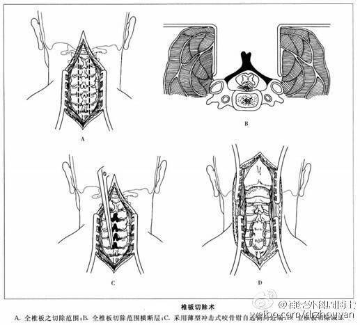 但是,传统的全椎板切除入路有其弊端,使得术后的病情恢复变得有些复杂