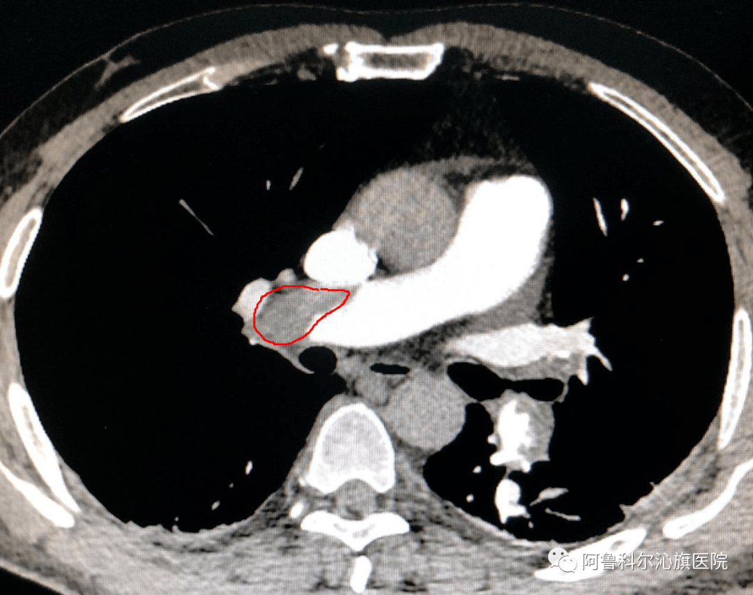 溶栓后肺动脉cta证实为双肺动脉主干栓塞