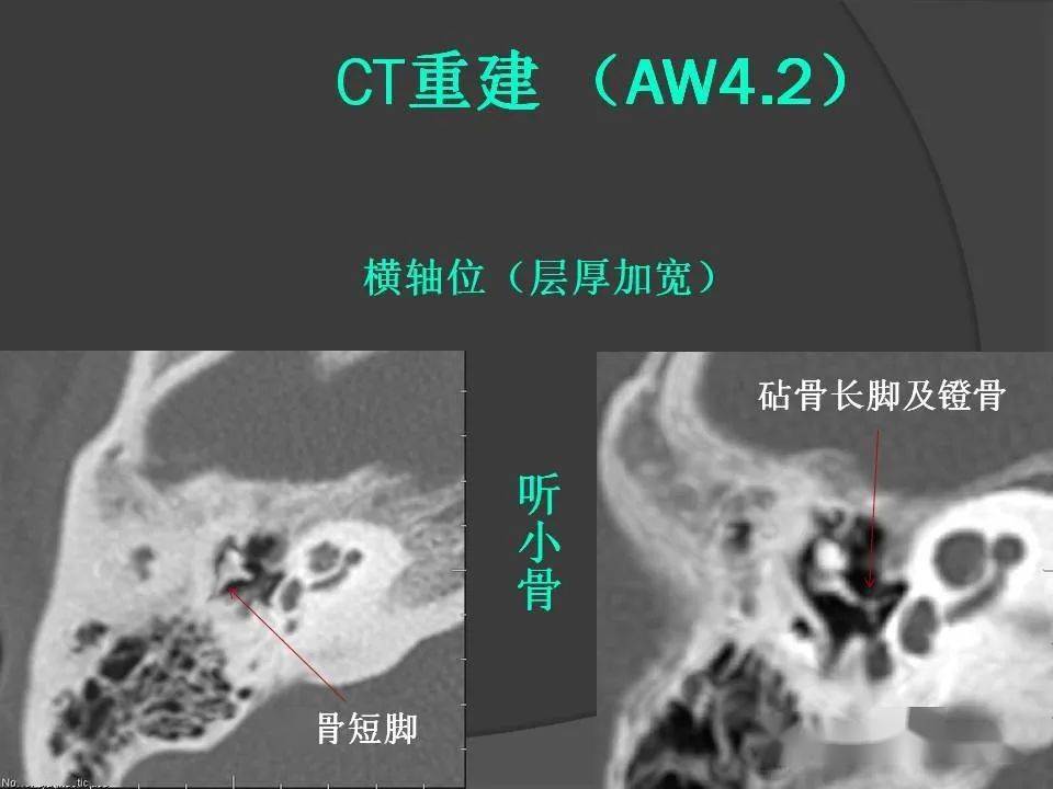 颞骨断层解剖及ct三维重建