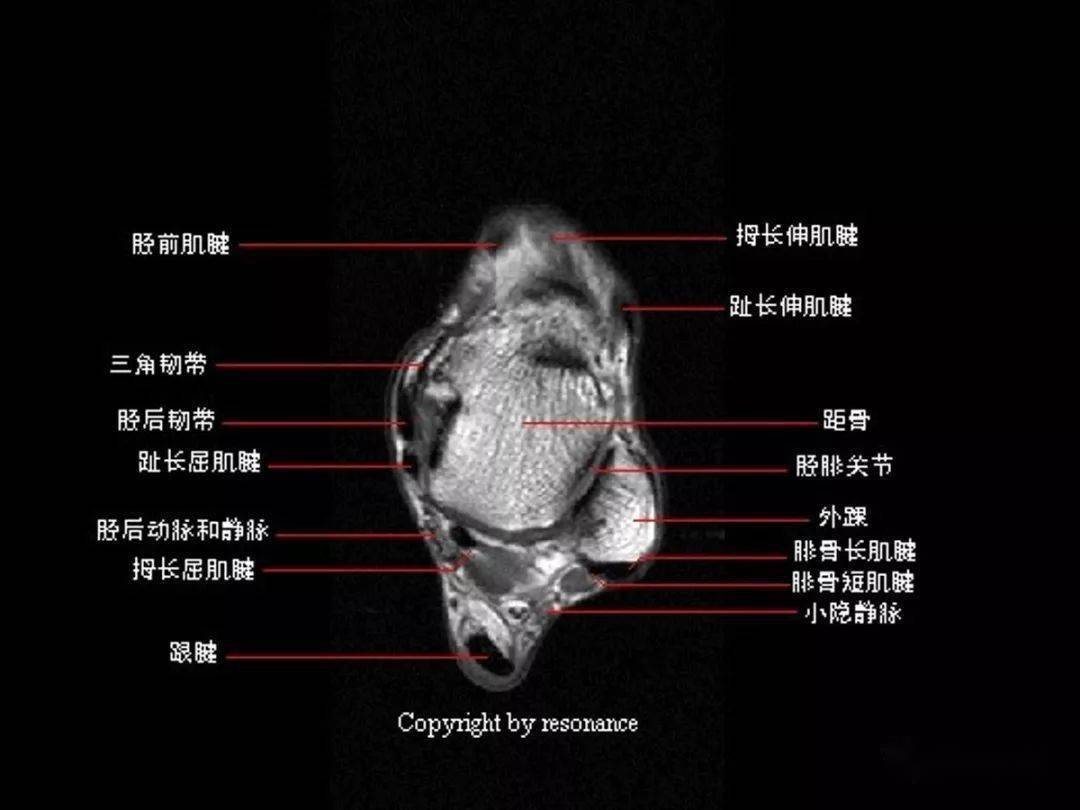 踝关节mri解剖和常见损伤类型