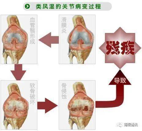 南华县人民医院科普专栏第13期您还在为类风湿性关节炎困扰吗
