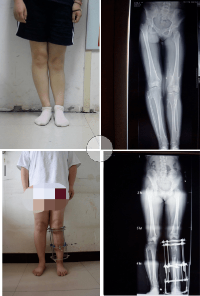 儿童罗圈腿长短腿不可怕微创治疗有办法小儿骨科Ⅱ脊柱侧弯科11周年