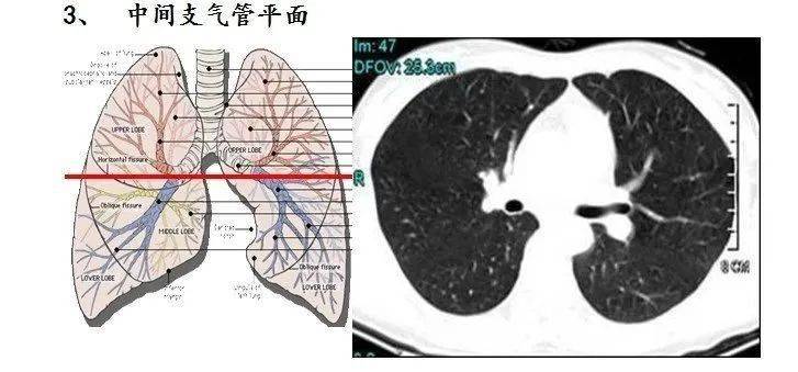 温故知新ct肺段定位口诀图文结合异常清晰