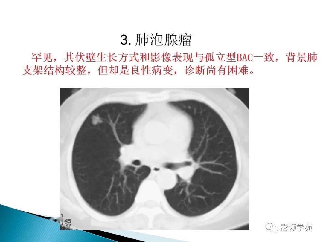 肺泡癌影像诊断与鉴别诊断