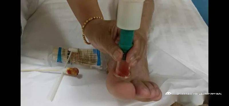 你以为的扭伤或许正是痛风作祟