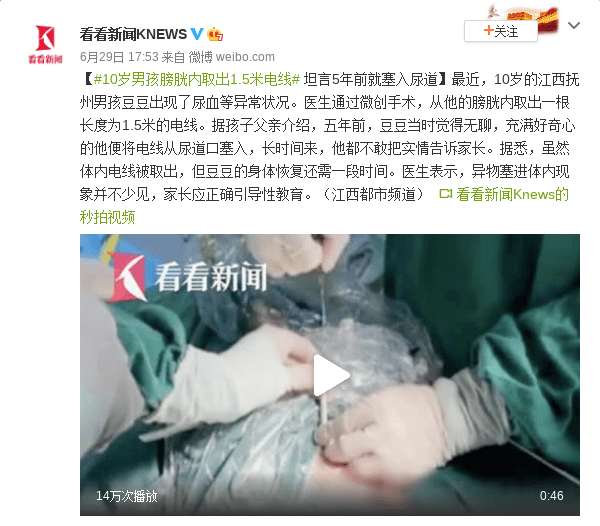 10岁男孩膀胱内取出1.5米电线 坦言5年前就塞入尿道