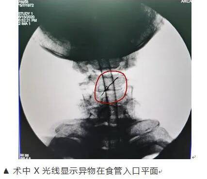 医生|男子食堂吃饭吞下2.5厘米金属针！如鲠在喉却找不到......