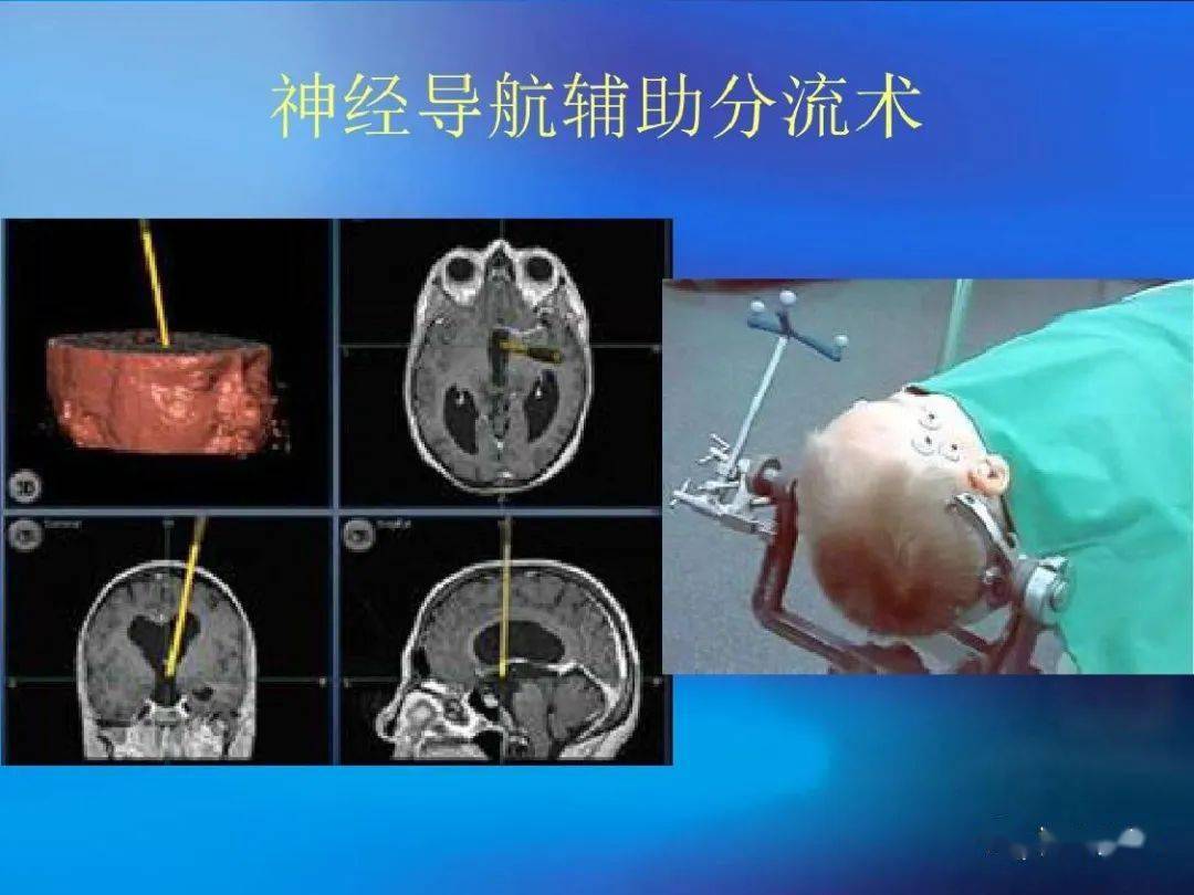 实用课件| 脑积水及分流术后并发症