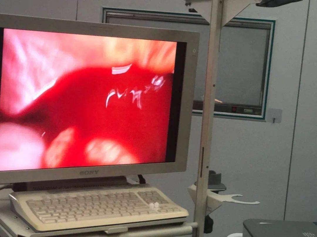 以新技术挽救新生命的行动为党的生日献礼||孝义市人民医院开展首例3D腹腔镜下脾破裂切除术