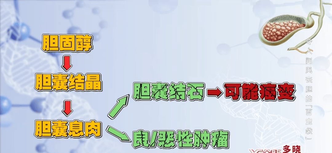 胆囊息肉会变癌吗得了就要一切了之吗