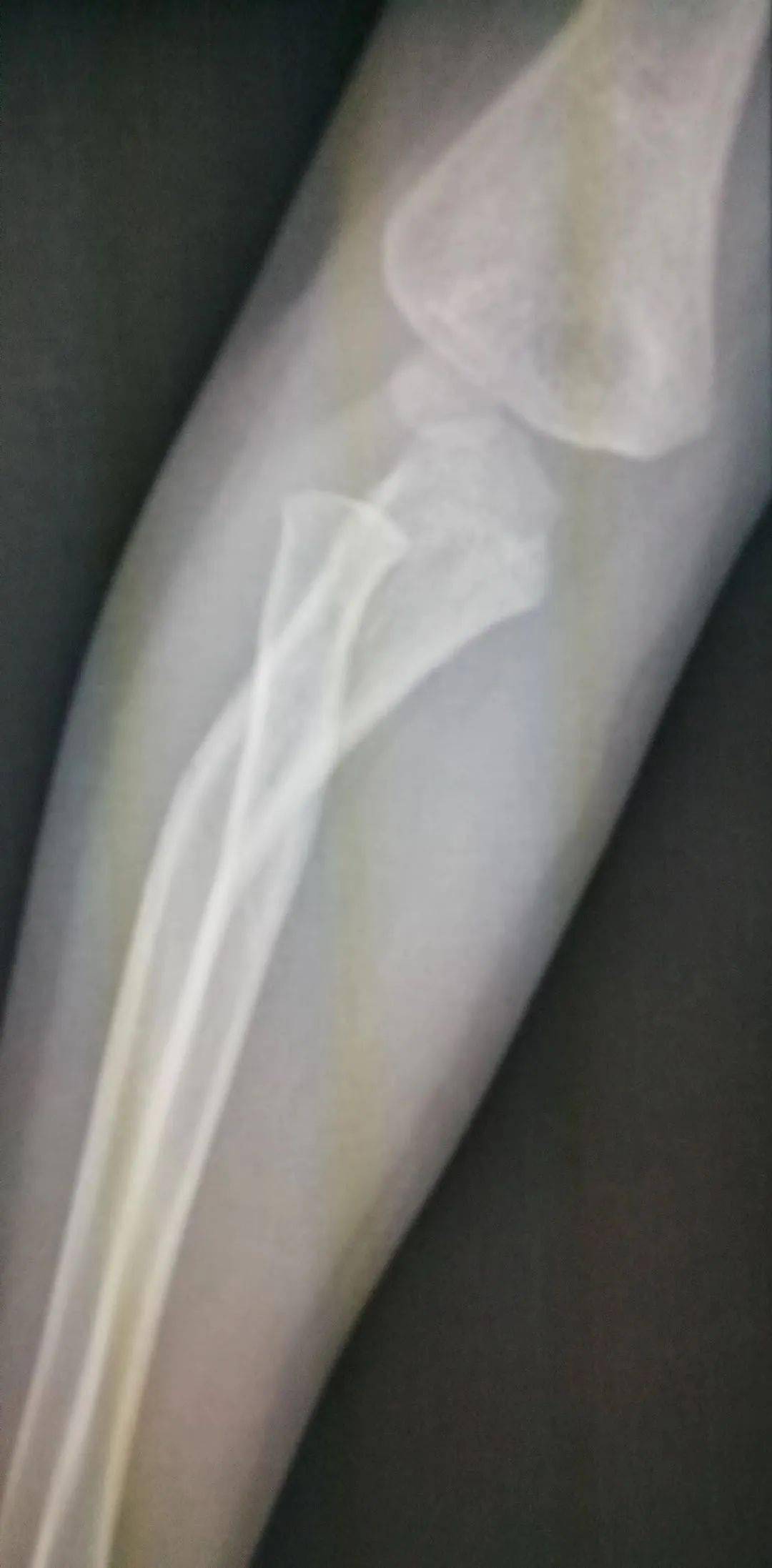 怎么看小孩有没有骨折 b68b0e37281843319de1a05ea2e6ebb4.jpeg