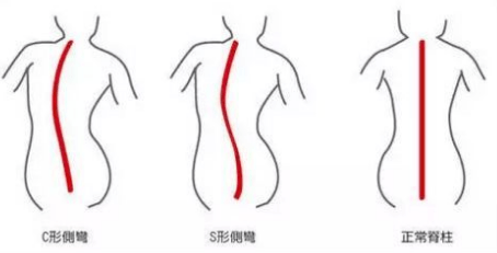 父母|12岁女孩弯腰时，父母发现不对劲！每10个孩子就有2个中招！