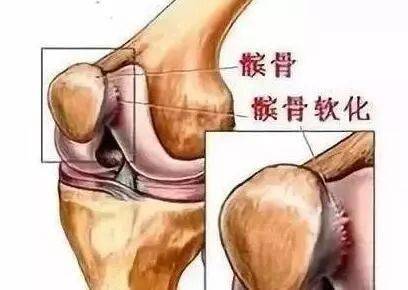 健康骨科丨走路经常"打软腿"?小心是膝盖出了问题!