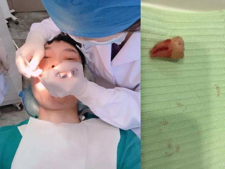 26岁小伙拔牙10天后脑出血死亡,或因细菌感染引起!