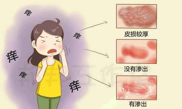 屁股瘙痒是什么毛病 7d1513112dcc4d9ba20bf2c4bdcca427.jpeg
