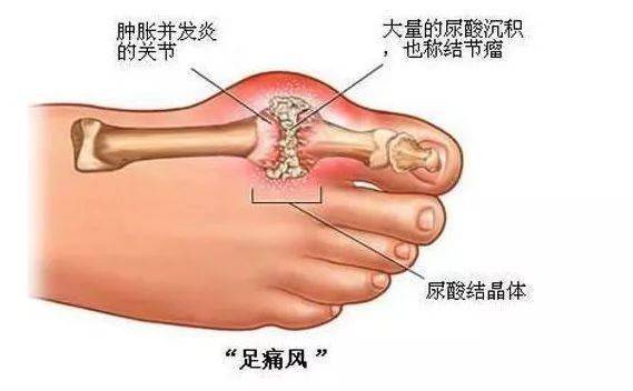 血脂|建议收藏！各年龄段血压、血糖、血脂、尿酸对照表看这里！