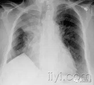 与一侧肺体积减小有关(例如放疗后纤维化或者肺叶切除术后相关的肺