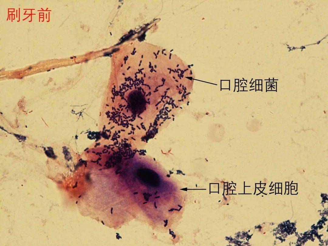 刷牙前口腔细菌量