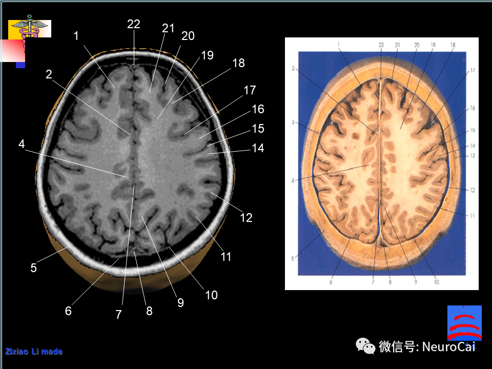 4,中央前回 5,中央沟 6,中央后回 7,蛛网膜下腔 8,边缘沟 9,大脑镰 10