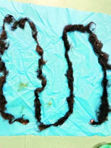 宫颈|51岁女子肚里发现罕见畸胎瘤