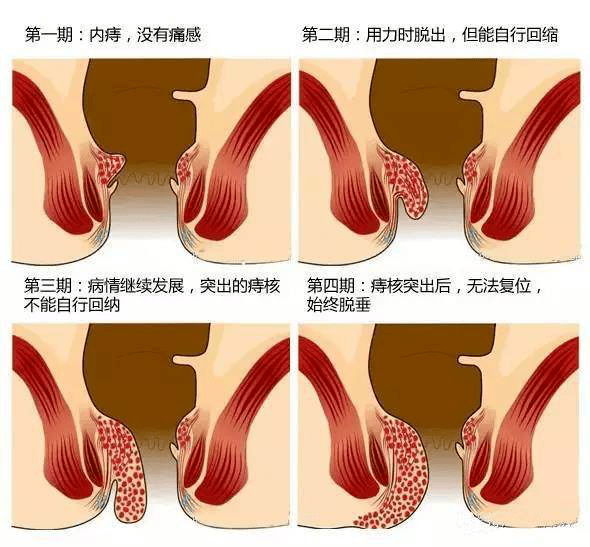 内痔  发生在齿状线以上,主要由不受我们主观意识控制的植物神经所