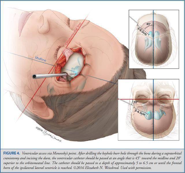operativeneurosurgery颅骨测量与脑室穿刺
