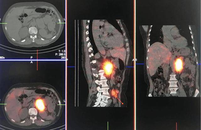 131-间碘苄胍(131i-mibg)spect-ct显像新技术研究.