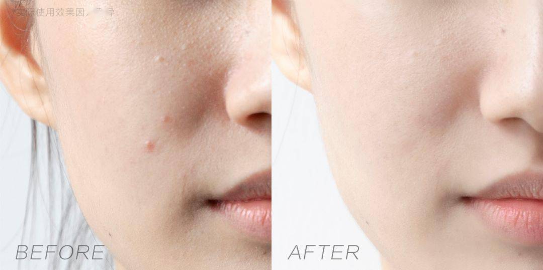 黑头|沈梦辰没骗我！HFP这些宝藏单品，真的让我“一夜换脸”！