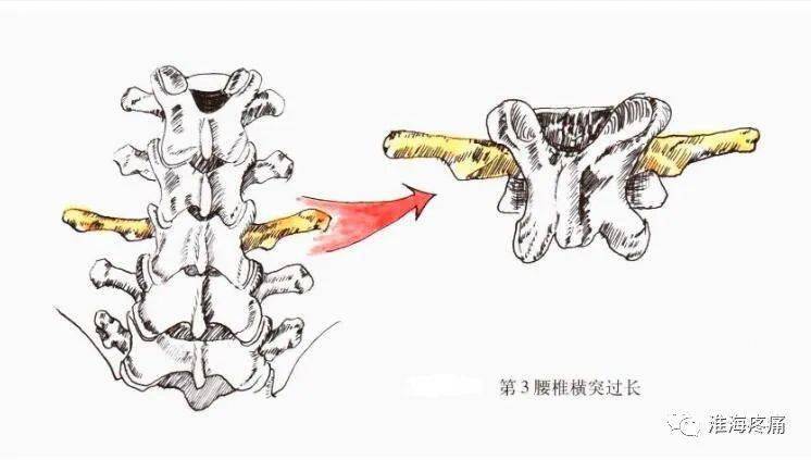 腰椎横突综合症的发生及临床特点,与局部的骨骼,肌肉及神经的解剖特点